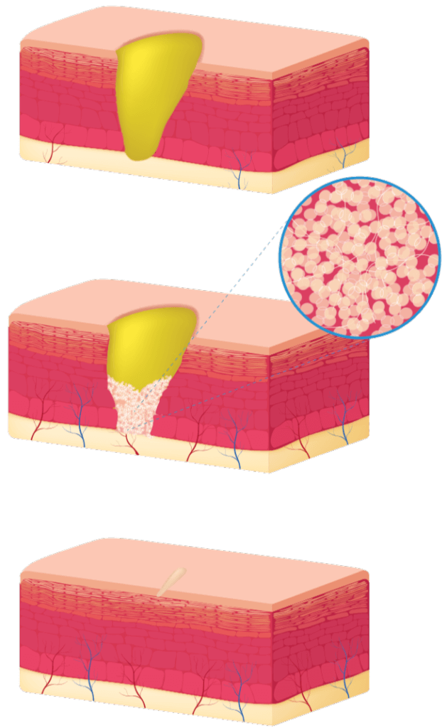 Illustration showcasing the state-of-the-art wound healing technology steps in the USA